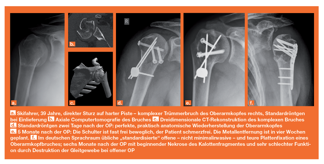 Minimalinvasive von schulternahen Oberarmbrüchen Das Medizinprodukt